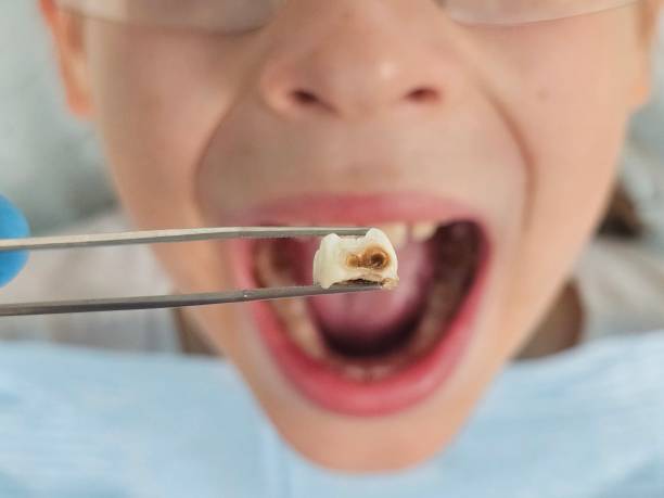 Best Emergency Dental Extractions in North Palm Beach, FL